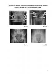 Способ стабилизации лонного сочленения при повреждениях тазового кольца типа в и с по классификации ao/asif (патент 2600490)