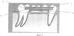 Мостовидный протез для восстановления отсутствующих второго премоляра и/или первого моляра прямым методом (патент 2333733)