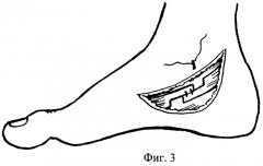 Способ хирургического лечения молоткообразной деформации ii-iv пальцев (патент 2285476)