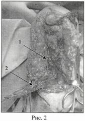 Способ лечения разгибательной контрактуры локтевого сустава у больных с артрогрипозом (патент 2458647)
