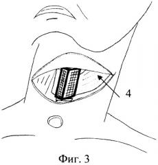 Способ хирургического лечения рака гортани (патент 2445014)