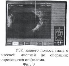 Способ склерореконструктивного лечения высокой близорукости (патент 2367394)