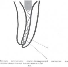 Способ оценки качества обработки корневых каналов зуба при эндодонтическом лечении (патент 2381766)