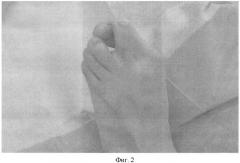Способ лечения вальгусной деформации 1-го пальца стопы при детском церебральном параличе (патент 2489108)