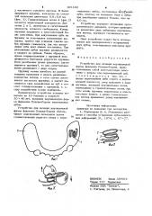 Устройство для лечения вертикальной формы феномена попова- годона (патент 931182)