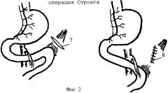 Способы хирургического лечения хронической дуоденальной непроходимости (варианты) (патент 2302823)