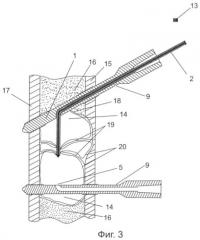 Способ лечения кист костей и устройство для его осуществления (патент 2420243)