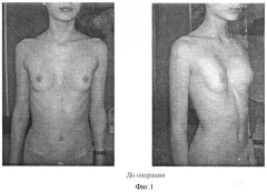 Способ хирургического лечения воронкообразной деформации грудной клетки (патент 2372864)