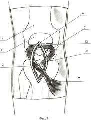 Способ хирургического лечения застарелого разрыва связки надколенника (патент 2471446)
