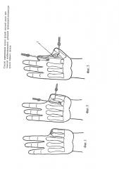 Способ перемещения культи второй пястной кости при тяжелой комбинированной рубцовой приводящей контрактуре культи первого пальца (патент 2662649)