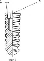 Внутрикостный дентальный имплантат (патент 2325133)