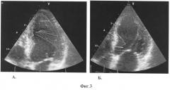 Способ диагностики недостаточности сократительной функции миокарда (патент 2354301)