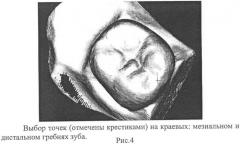 Способ контроля препарирования окклюзионной поверхности зубов при ортопедическом лечении несъемными протезами (патент 2396921)