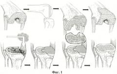 Способ замещения костных дефектов мыщелков большеберцовой или бедренной костей при тотальном эндопротезировании коленного сустава (патент 2465855)