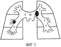 Способ ведения пациентов при тромбоэмболии легочной артерии (патент 2526469)
