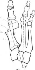 Способ коррекции оси 1 плюсневой кости при лечении hallux valgus (патент 2578543)