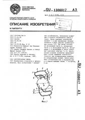 Внутриглазная линза (патент 1386017)