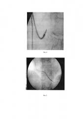 Способ хирургического лечения недостаточности миокарда левого желудочка (патент 2648883)