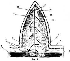 Способ ушивания лапаротомной раны (патент 2261665)
