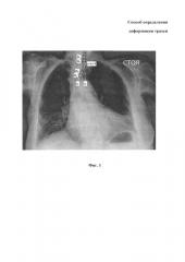 Способ определения деформации трахеи (патент 2611928)