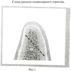 Способ пластики альвеолярного отростка нижней челюсти при его атрофии (патент 2414181)