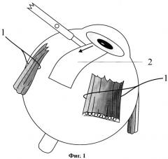 Способ хирургического лечения неоваскулярной формы вторичной глаукомы (патент 2248191)