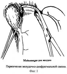 Способ фундопликации (патент 2291672)