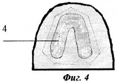 Способ протезирования зубов при пластике альвеолярного отростка (патент 2268682)