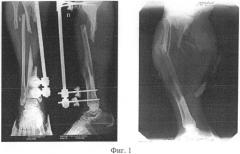 Способ замещения посттравматического дефекта большеберцовой кости, сопровождающегося обширной раневой поверхностью (патент 2487684)