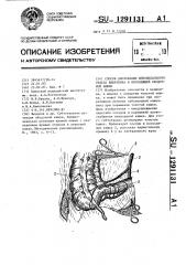 Способ дислокации илеоцекального отдела кишечника и восходящей ободочной кишки (патент 1291131)