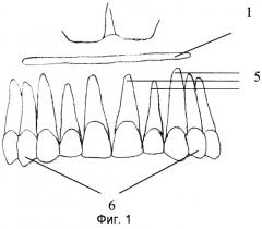 Способ лечения протрузии зубов (патент 2297194)