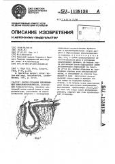 Способ создания удерживающей илеостомы-резервуара (патент 1138138)