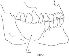 Способ устранения дефекта альвеолярного отростка челюсти (патент 2456945)