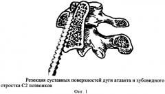 Способ фиксации двух верхних шейных позвонков (патент 2428948)