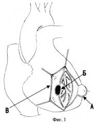Способ закрытия постинфарктного межжелудочкового дефекта с одновременным устранением аневризмы сердца (патент 2266714)