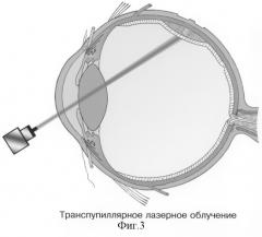 Способ хирургической электрохимической деструкции и фотодинамического лечения внутриглазных новообразований (патент 2243755)