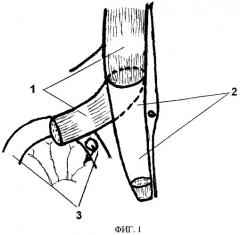 Способ пластики задней стенки влагалища прямой мышцы живота при хирургическом лечении несформированных свищей желудочно-кишечного тракта мышечным лоскутом на сосудистой ножке (патент 2448655)