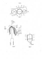 Зубная коронка (патент 988283)