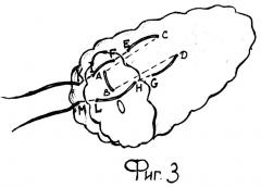 Способ формирования культи поджелудочной железы при наложении панкреатоеюноанастомоза (патент 2256413)