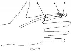 Способ тендопластики сгибателей кисти при травматической ампутации пальца (патент 2499572)