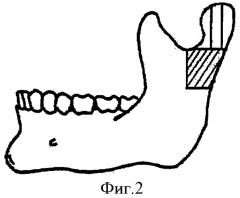 Способ хирургического лечения костного анкилоза височно-нижнечелюстного сустава и недоразвития нижней челюсти (патент 2411921)