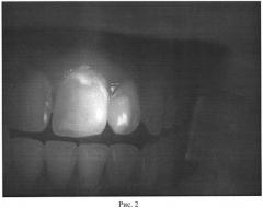 Способ диагностики начального кариеса зубов (патент 2538614)