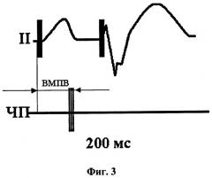 Способ определения атриовентрикулярной задержки в двухкамерных электрокардиостимуляторах (патент 2372114)
