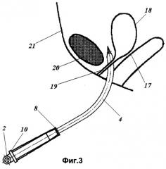 Способ данилова-вольных лечения недержания мочи у женщин и хирургический инструмент для его осуществления (патент 2261056)