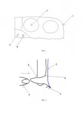 Способ профилактики серомы при лапароскопической паховой герниопластике прямой паховой грыжи (патент 2625445)
