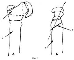Способ реконструкции проксимального отдела бедренной кости при юношеском эпифизеолизе головки бедра (патент 2364365)