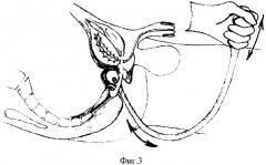 Инструмент для поиска культи прямой кишки в полости малого таза при реконструктивных операциях на толстой кишке (патент 2302812)