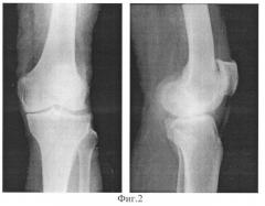 Способ диагностики тяжести остеоартроза коленного сустава (патент 2332923)
