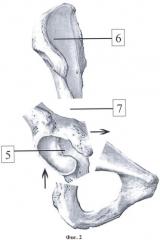 Способ выполнения транспозиции вертлужной впадины в ходе тройной остеотомии таза (патент 2432132)