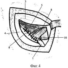 Способ пластики пахового канала с использованием пирамидальной мышцы (патент 2295299)
